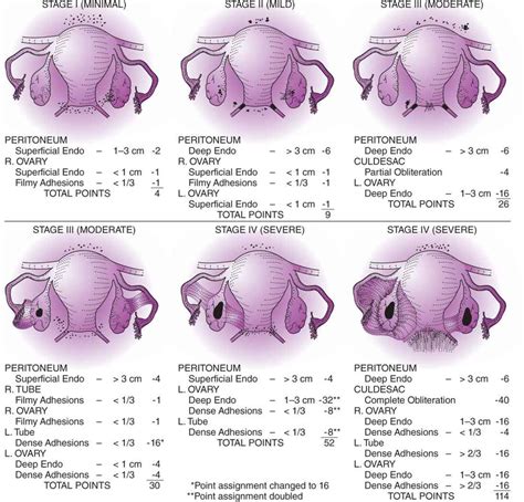 endometriosis staging acog